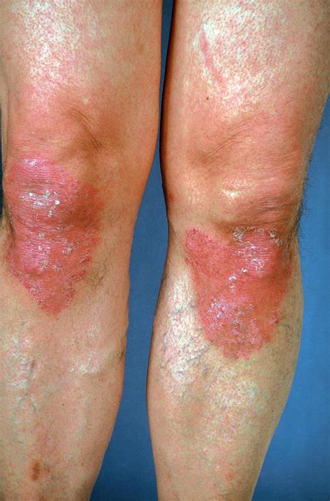 psoriasis knees